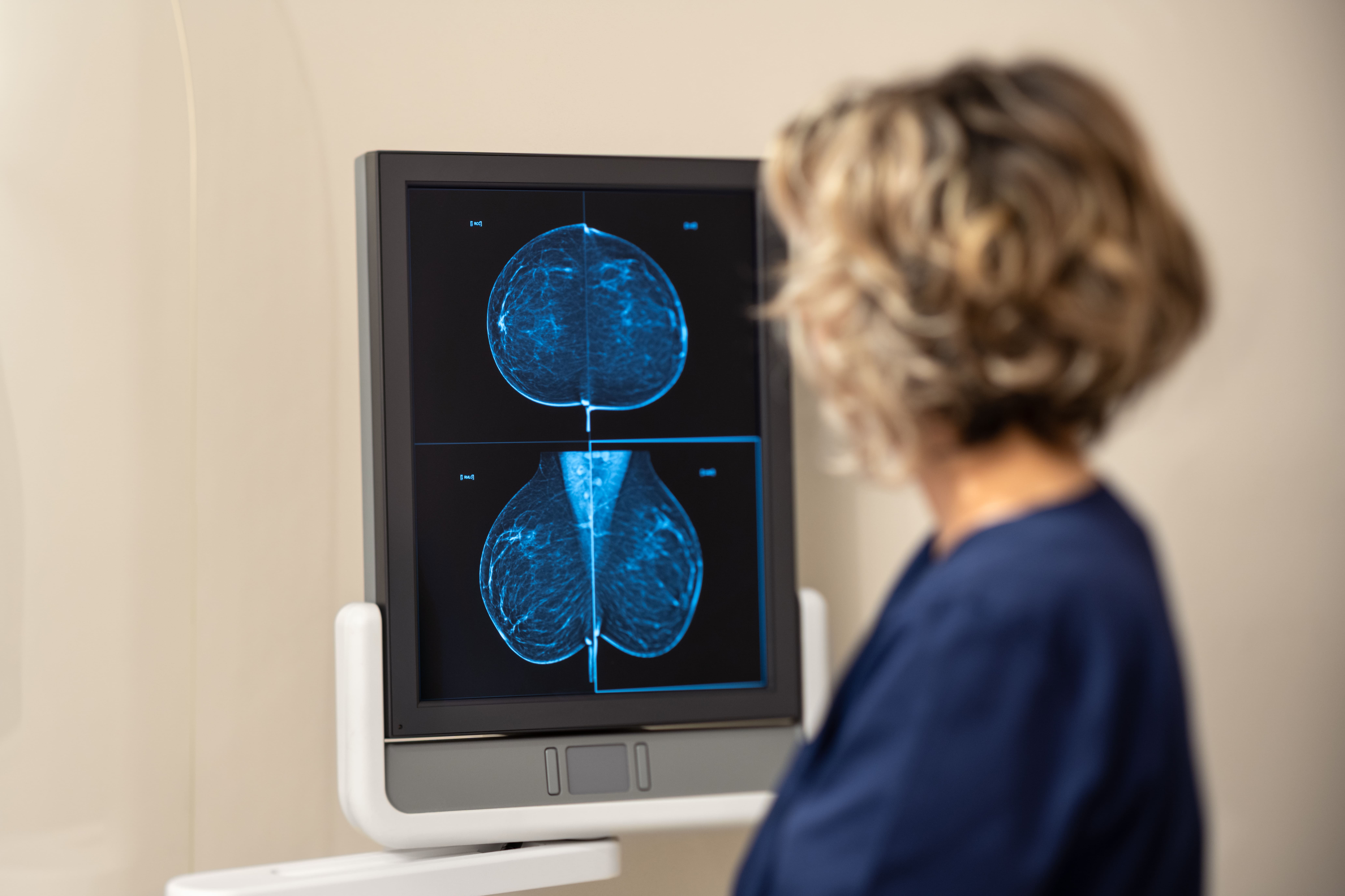 Ärztin betrachtet Mammographiebilder auf einem Monitor